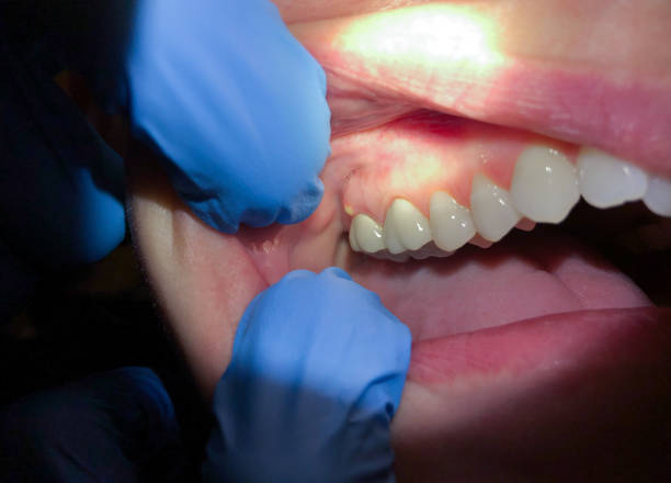 Best Emergency Gum Treatment in Youngwood, PA
